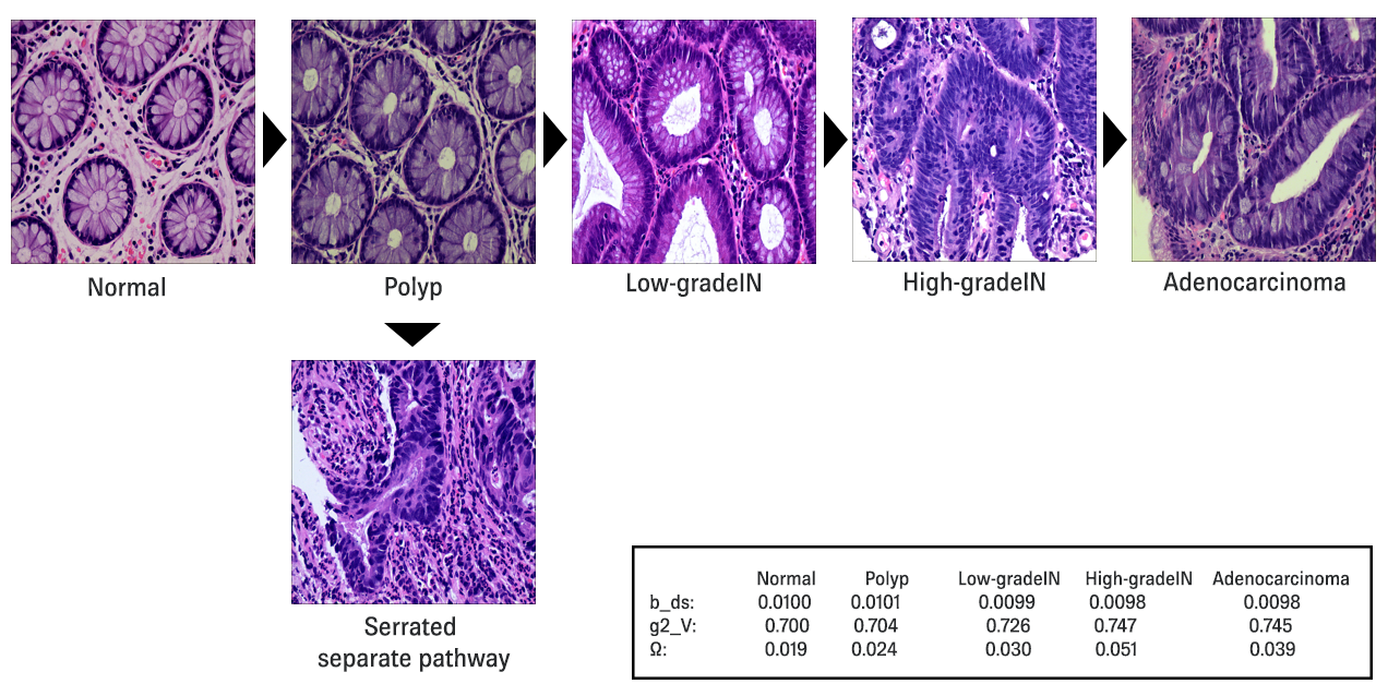 Normal colonic mucosa progressing through dysplastic states
