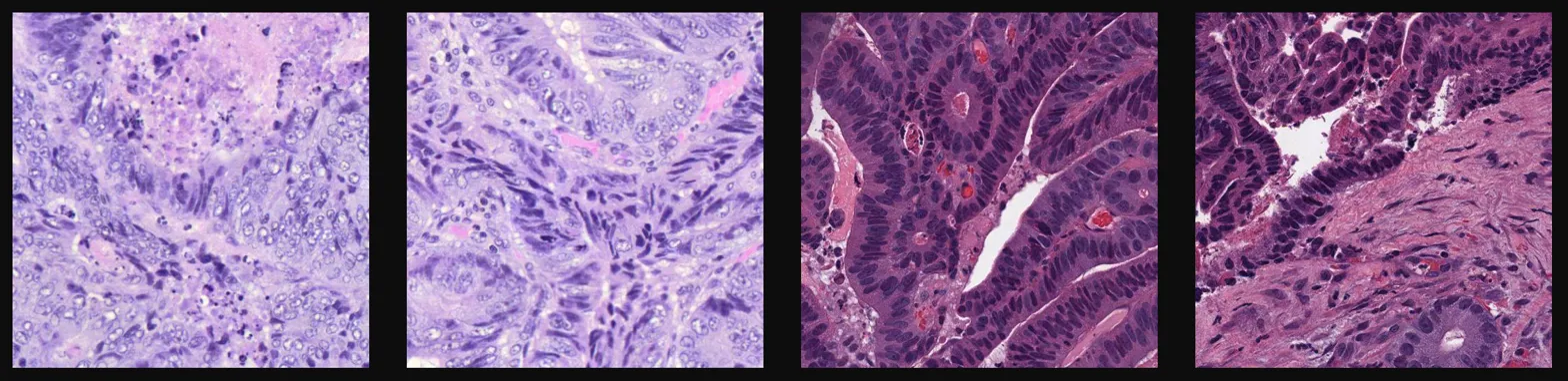 H&E histology comparison — structural heterogeneity vs consolidation, same stage, different survival